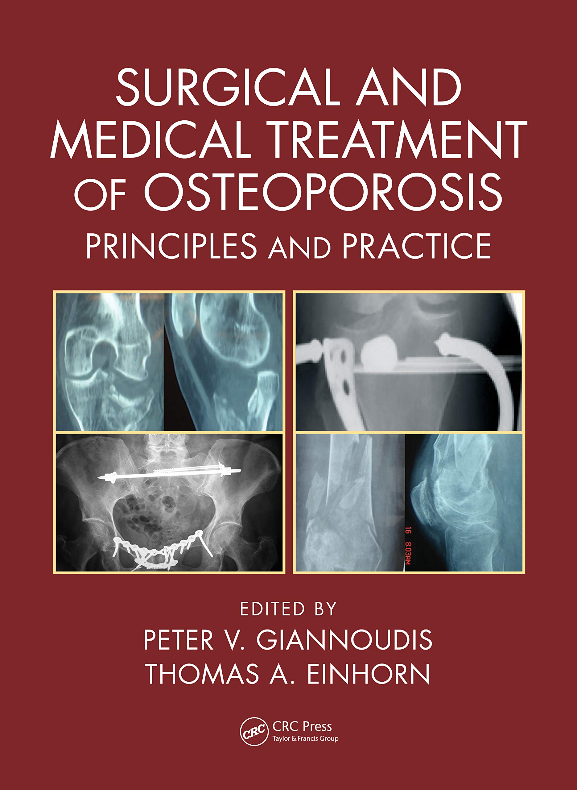 Surgical and Medical Treatment of Osteoporosis: Principles and Practice - 1st Edition